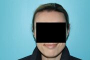 Ear Reshaping - Otoplasty