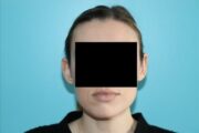 Ear Reshaping - Otoplasty