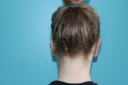 Ear Reshaping - Otoplasty