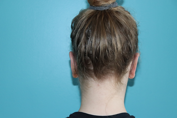 Ear Reshaping - Otoplasty Case 49588 After Photo Ear Reshaping - Otoplasty