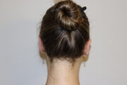 Ear Reshaping - Otoplasty