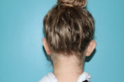 Ear Reshaping - Otoplasty