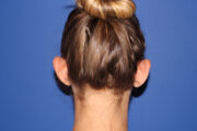 Ear Reshaping - Otoplasty