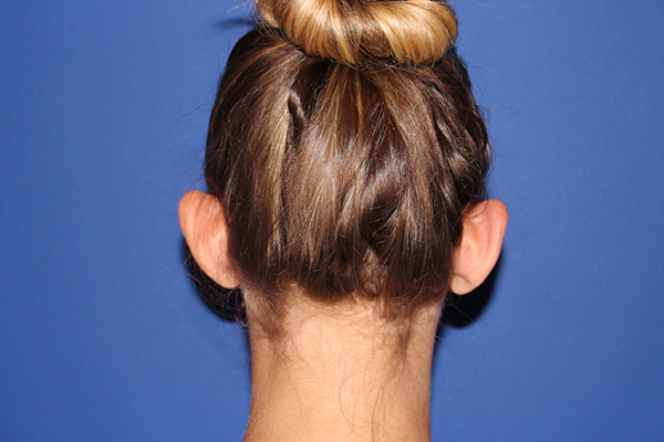 Ear Reshaping - Otoplasty