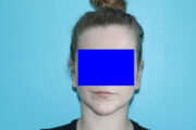 Ear Reshaping - Otoplasty