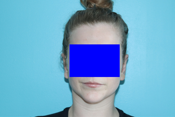 Ear Reshaping - Otoplasty Case 49588 After Photo Ear Reshaping - Otoplasty