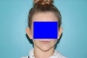 Ear Reshaping - Otoplasty