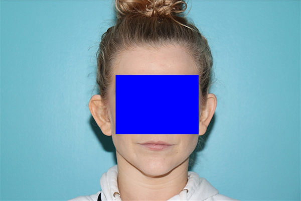 Ear Reshaping - Otoplasty Case 49588 Before Photo Ear Reshaping - Otoplasty