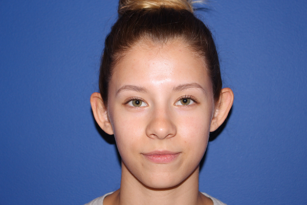 Ear Reshaping - Otoplasty