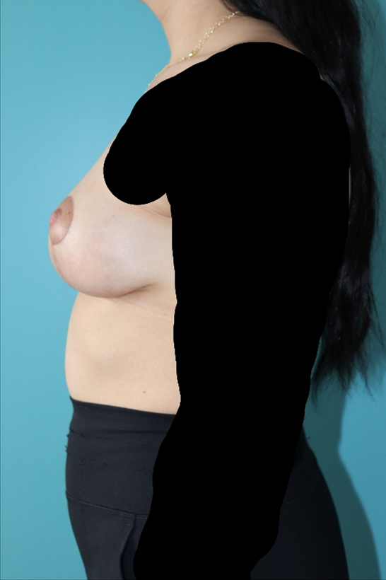 Breast Lift