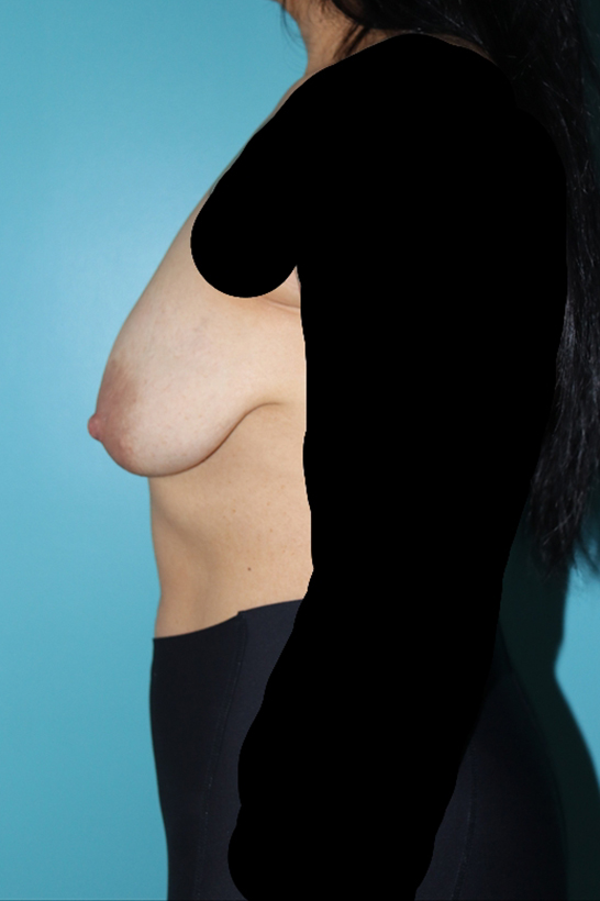 Breast Lift