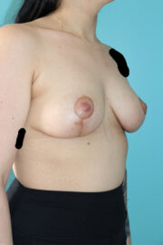 Breast Lift