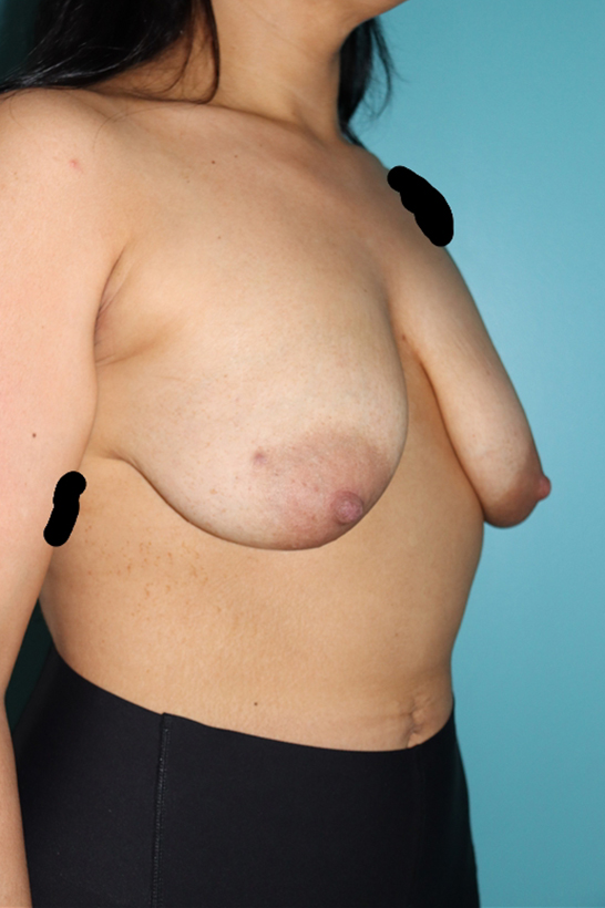 Breast Lift