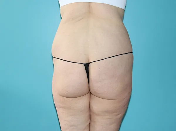 Body Contouring After Major Weight Loss