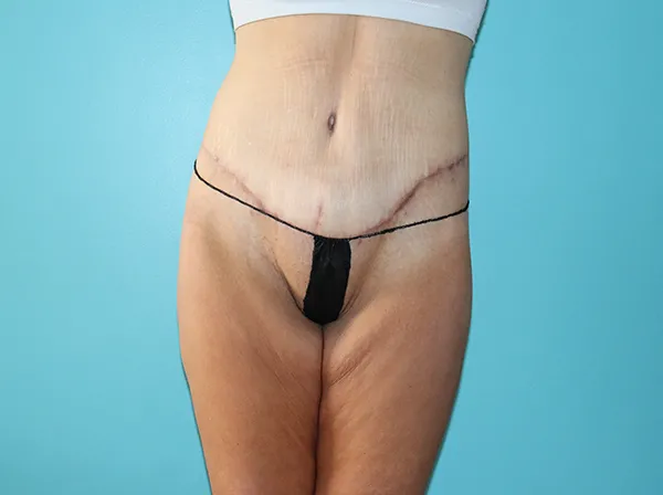 Body Contouring After Major Weight Loss