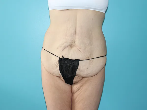 Body Contouring After Major Weight Loss