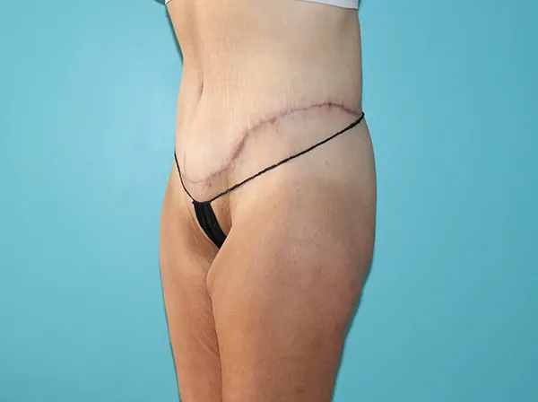 Body Contouring After Major Weight Loss