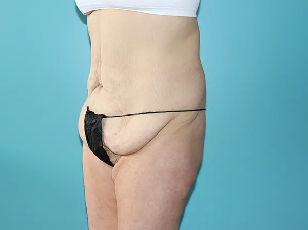Body Contouring After Major Weight Loss