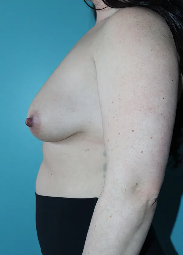 Breast Augmentation with Breast Lift Case 50018 Before Photo Breast Augmentation with Breast Lift