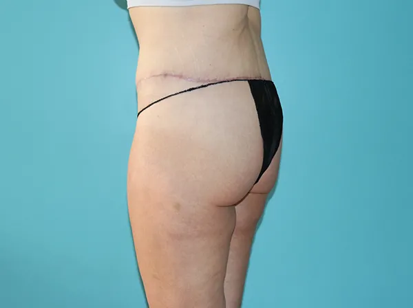 Body Contouring After Major Weight Loss