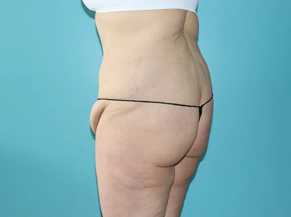 Body Contouring After Major Weight Loss