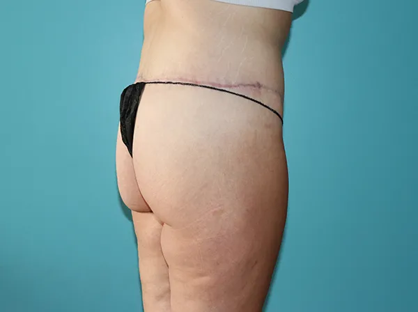 Body Contouring After Major Weight Loss