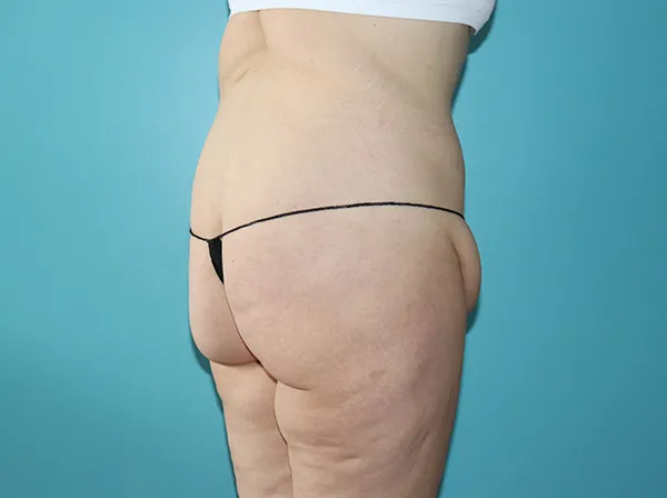 Body Contouring After Major Weight Loss
