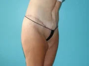 Body Contouring After Major Weight Loss