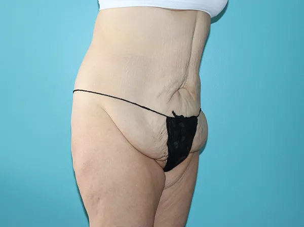 Body Contouring After Major Weight Loss
