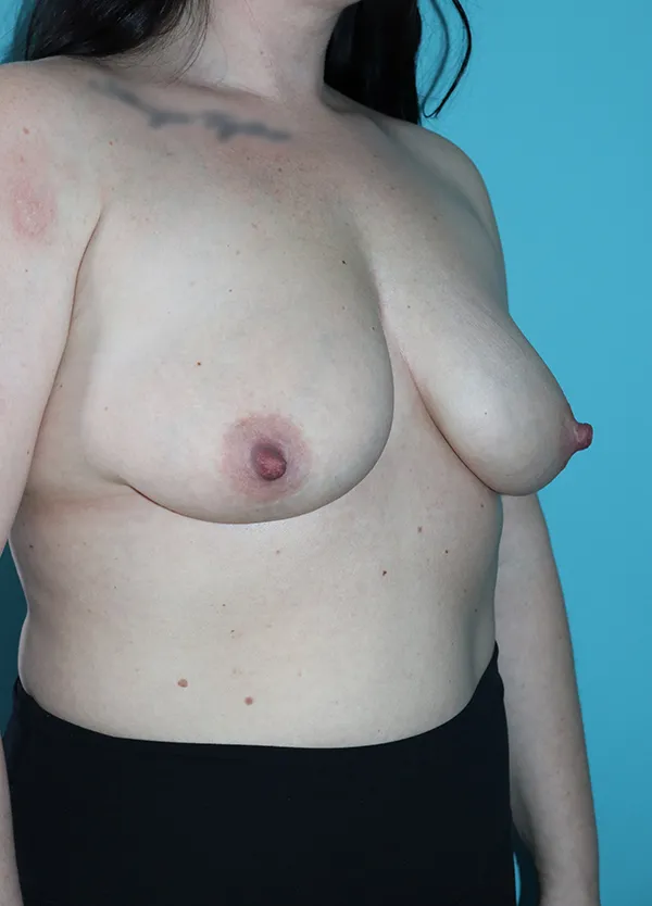 Breast Augmentation with Breast Lift Case 50018 Before Photo Breast Augmentation with Breast Lift