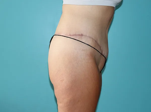 Body Contouring After Major Weight Loss