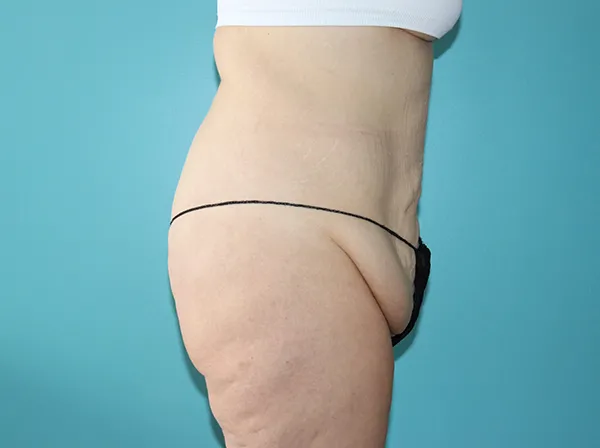 Body Contouring After Major Weight Loss