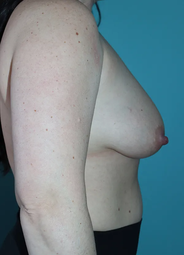 Breast Augmentation with Breast Lift Case 50018 Before Photo Breast Augmentation with Breast Lift