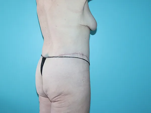 Body Contouring After Major Weight Loss