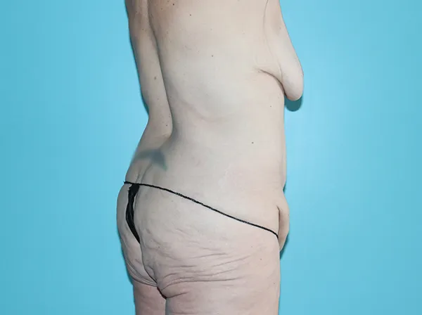 Body Contouring After Major Weight Loss