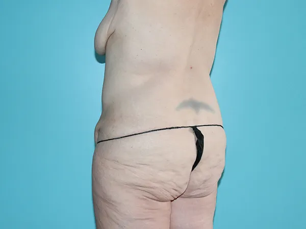 Body Contouring After Major Weight Loss