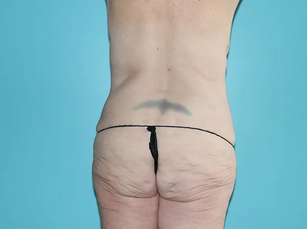 Body Contouring After Major Weight Loss