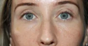 Eyelid Surgery