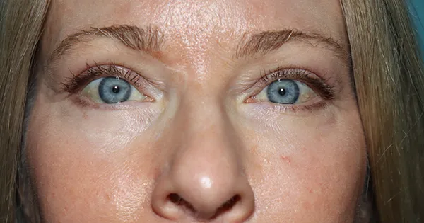 Eyelid Surgery