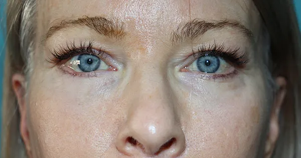 Eyelid Surgery