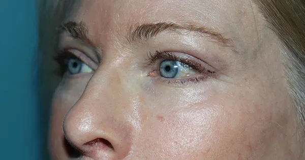 Eyelid Surgery