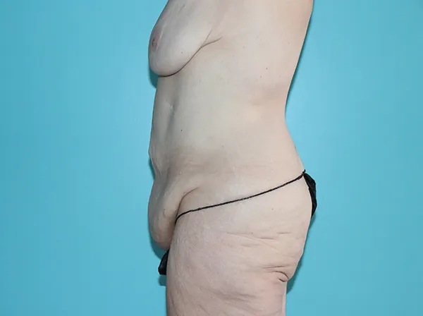 Body Contouring After Major Weight Loss