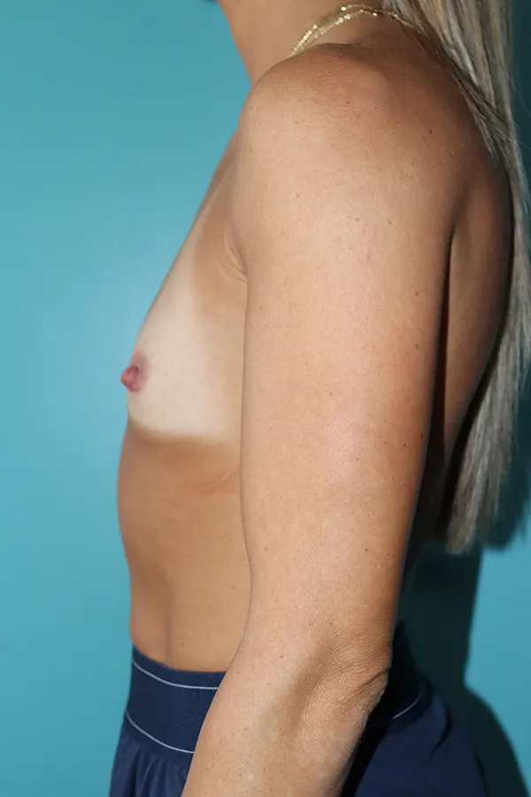 Breast Augmentation