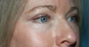 Eyelid Surgery