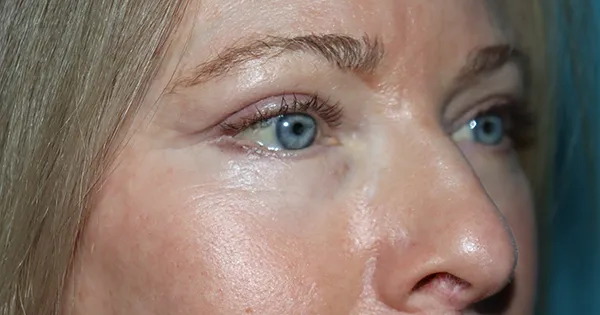 Eyelid Surgery