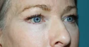 Eyelid Surgery