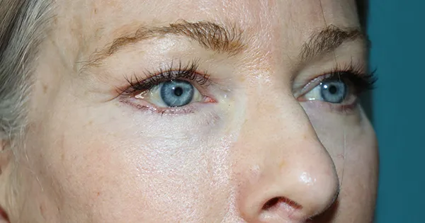 Eyelid Surgery
