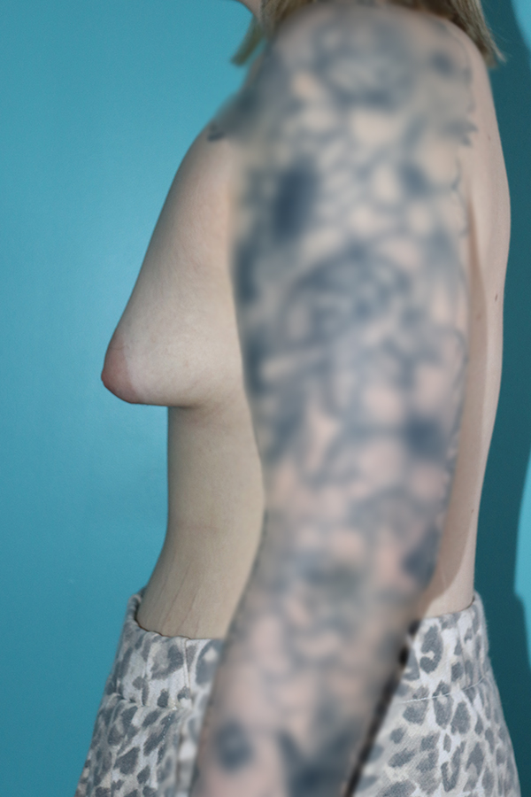 Breast Augmentation