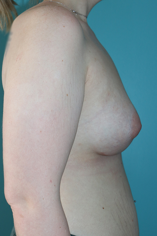 Breast Augmentation