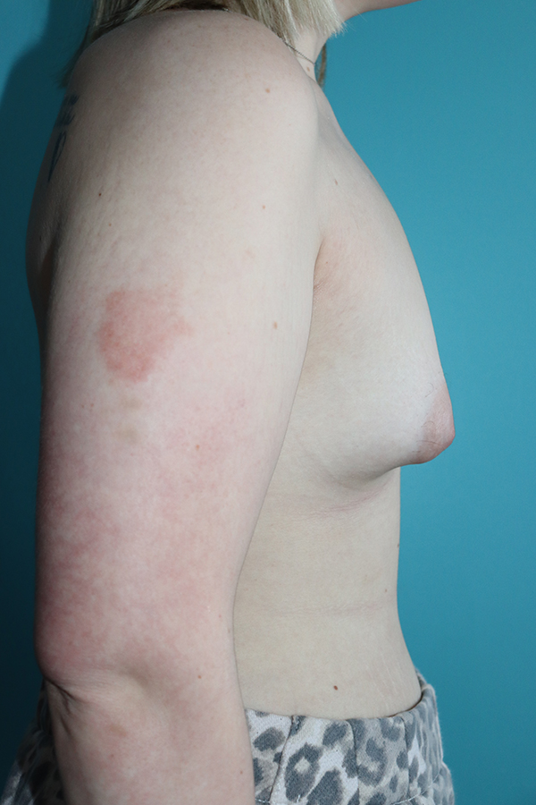 Breast Augmentation